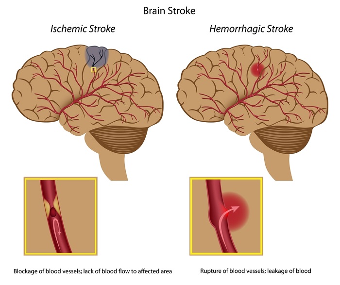 AVC ischemic, AVC hemoragic